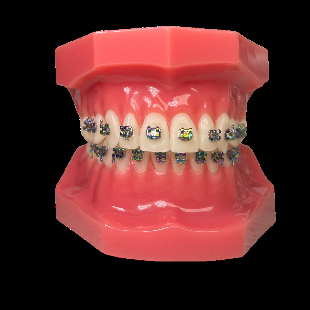 Imagine offers exclusive colored brackets on our braces, including rose gold, black, blue, and more.